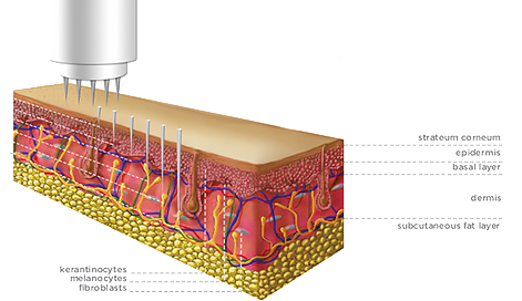 Microneedleing mit dem Dermapen im Kosmetikinstitut Atos Wellness in Bad Vöslau